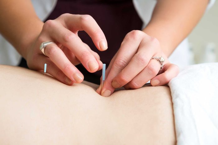 Woman applying acupuncture needles to a person's back.