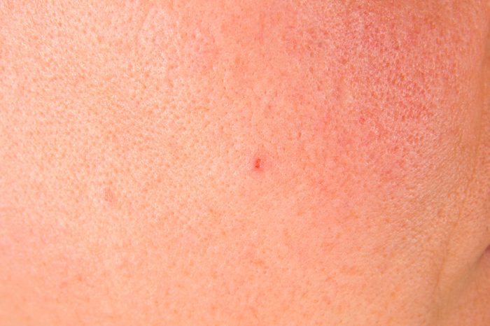 Close-up image of skin with large pores.