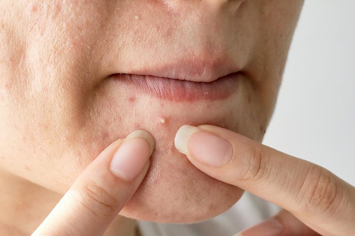 woman popping a pimple