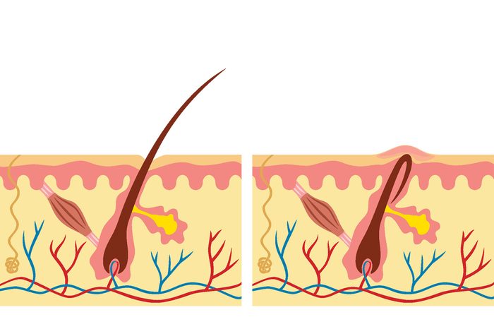 Illustration of an ingrown hair and a regular hair.