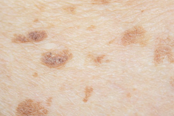 closeup of moles and freckles on skin