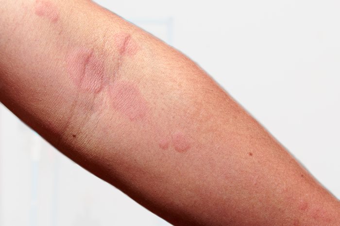 close up of arm rash spots skin irritation