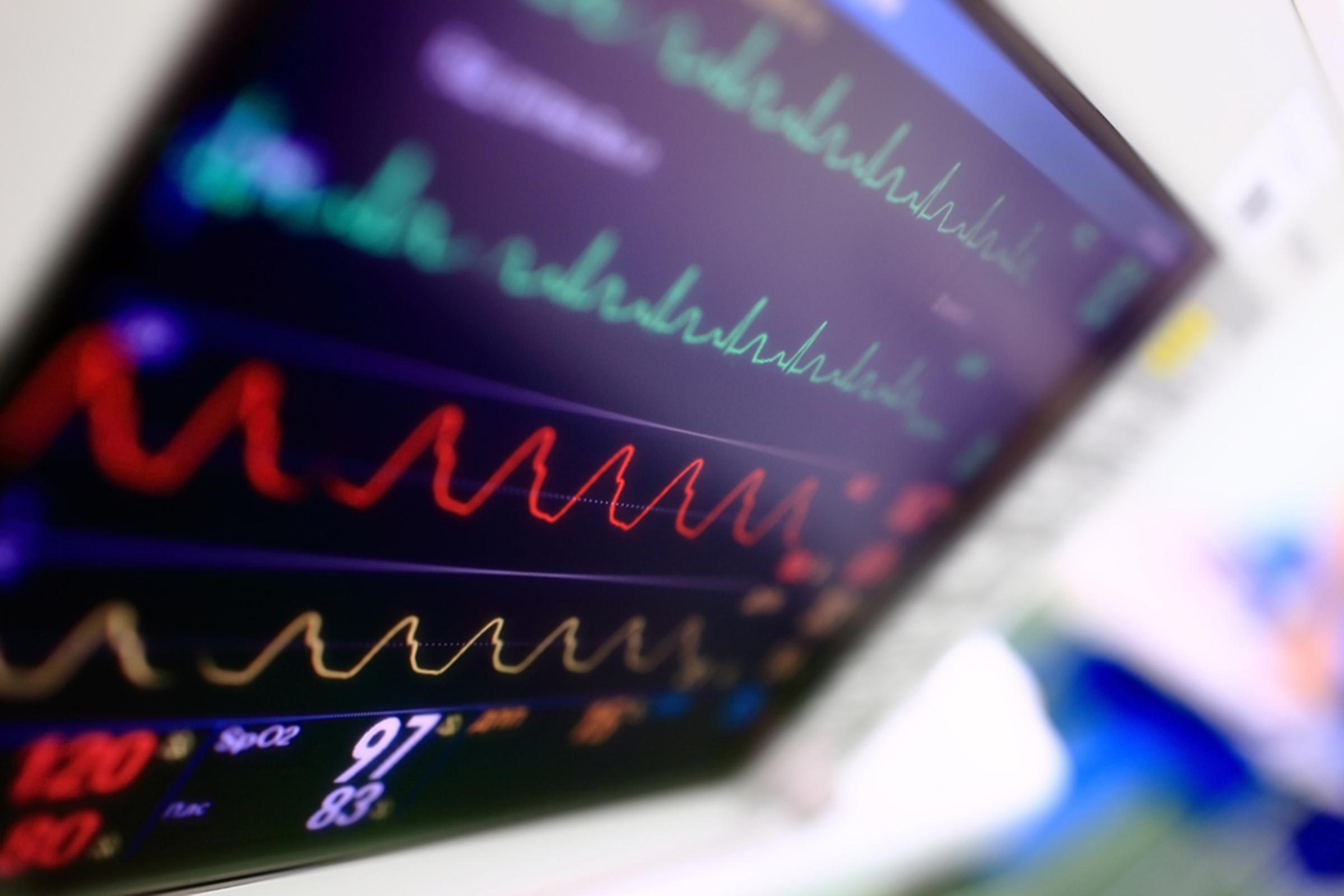 EKG machine screen at a hospital