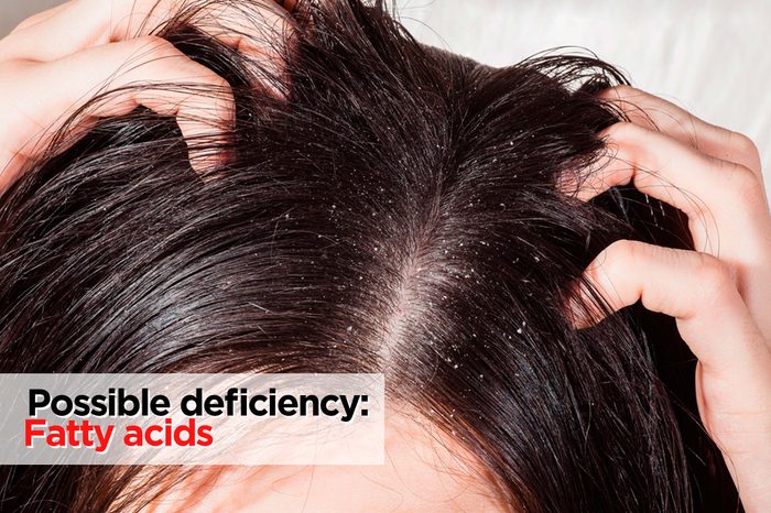 Close up of woman with hands in hair with dandruff