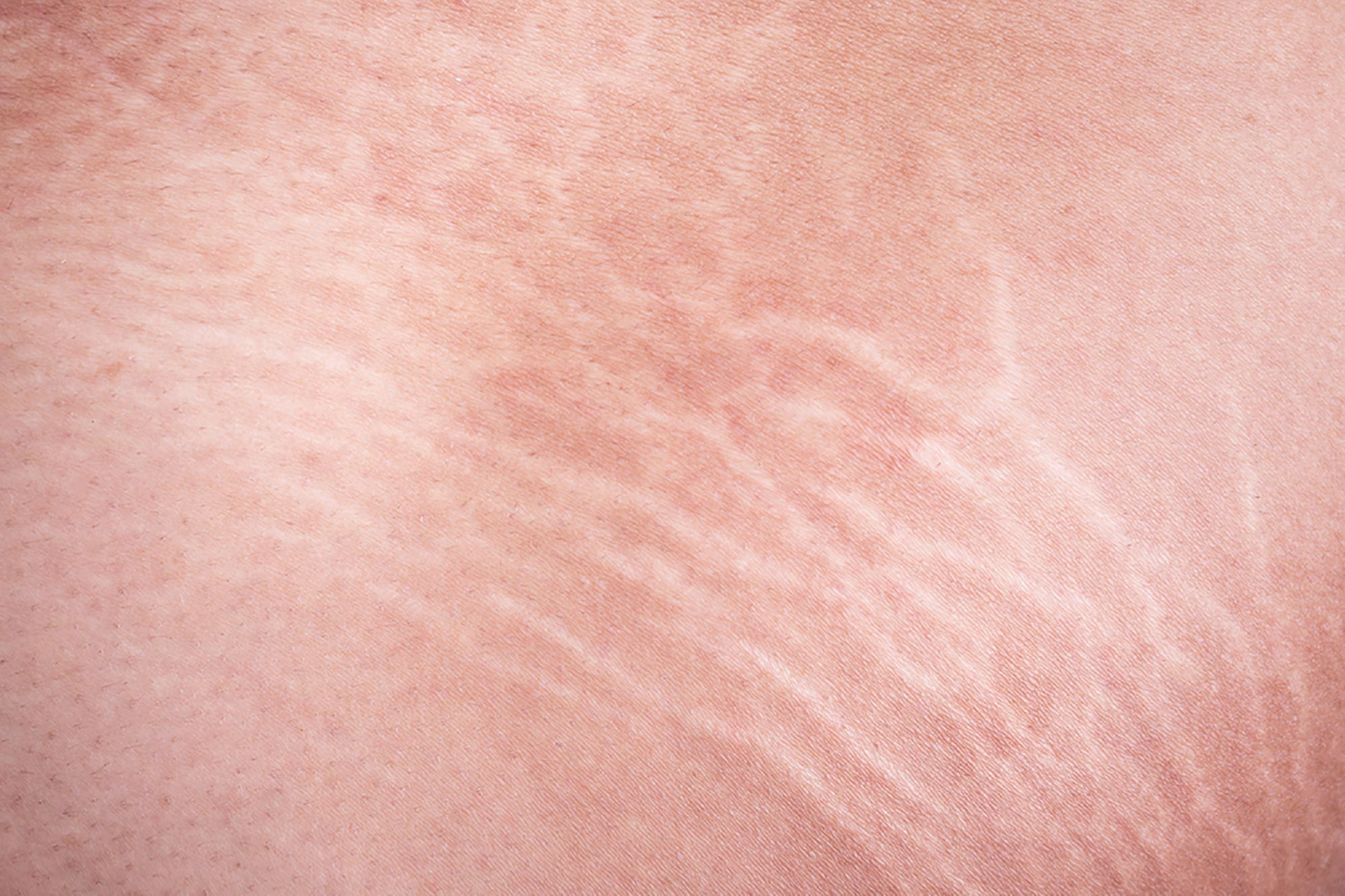 Closeup of stretch marks.