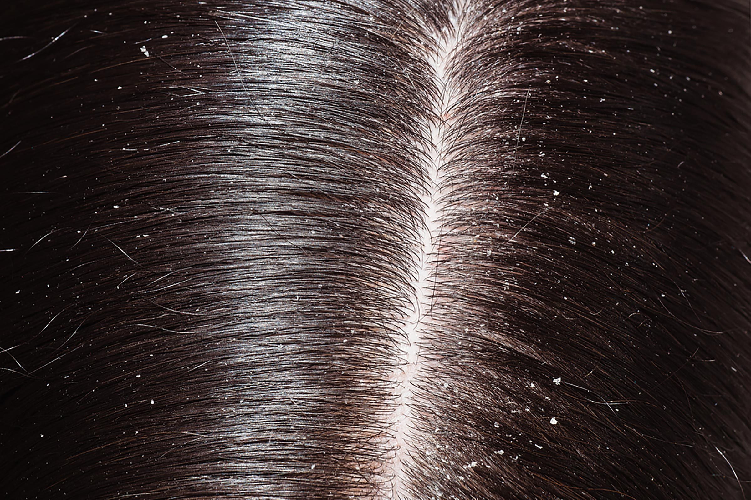 Dandruff along someone's hair part line.