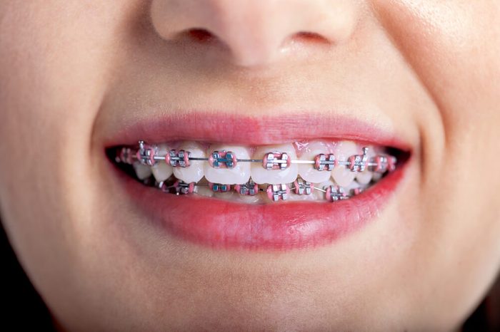 Young woman with brackets and braces on teeth.