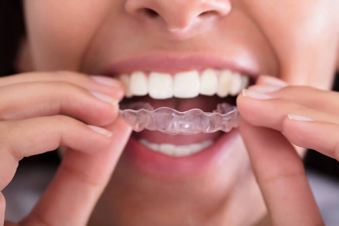 Woman putting a transparent aligner like Invisalign in her mouth.