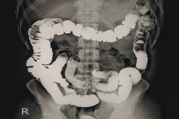 ultrasound of the intestine and gut