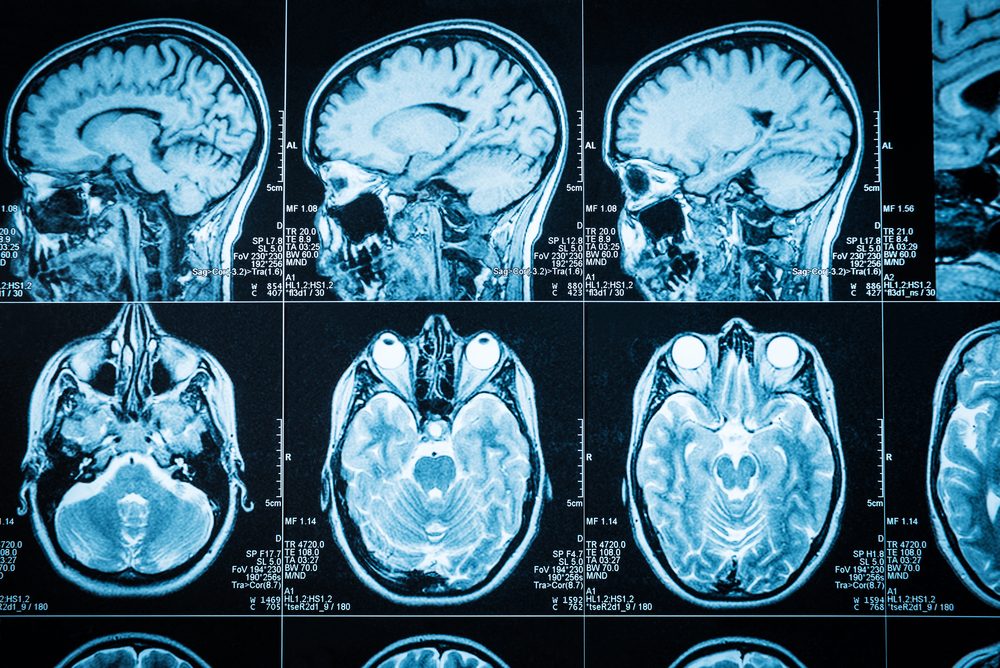 Closeup of a CT scan with brain