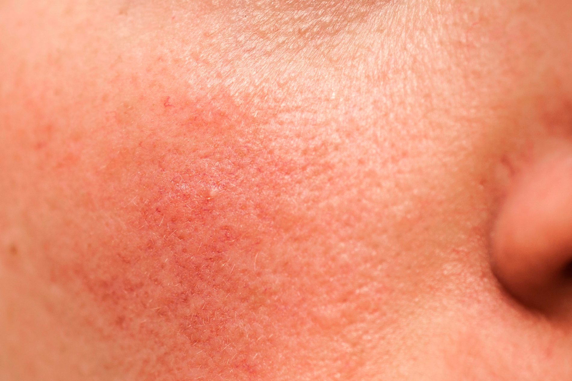 rosacea on face