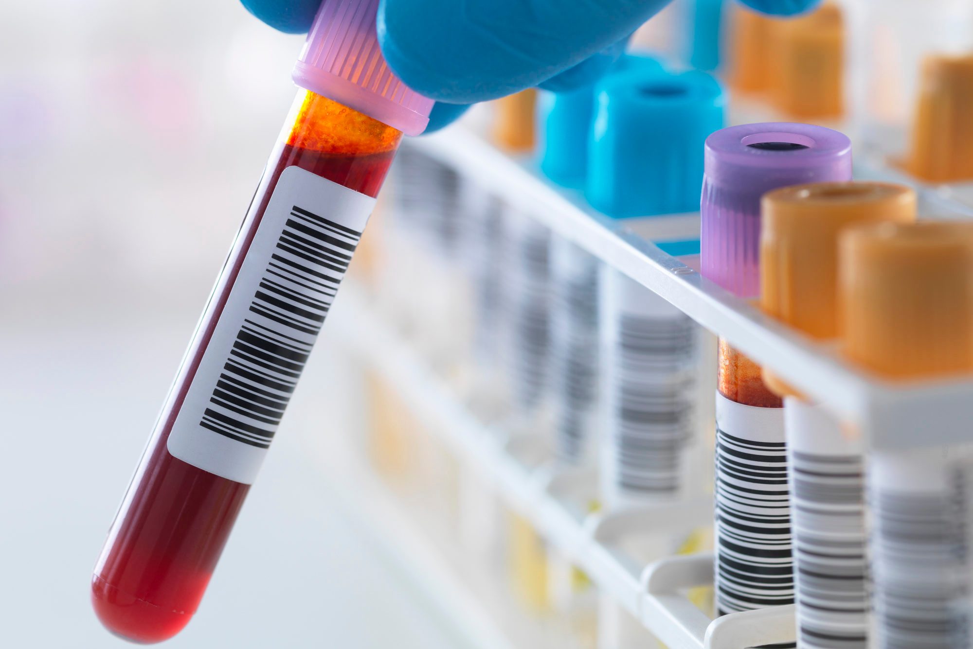 A blood sample being held with a row of human samples for analytical testing including blood, urine, chemistry, proteins, anticoagulants and HIV in lab