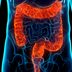 What You Need to Know About Ulcerative Colitis