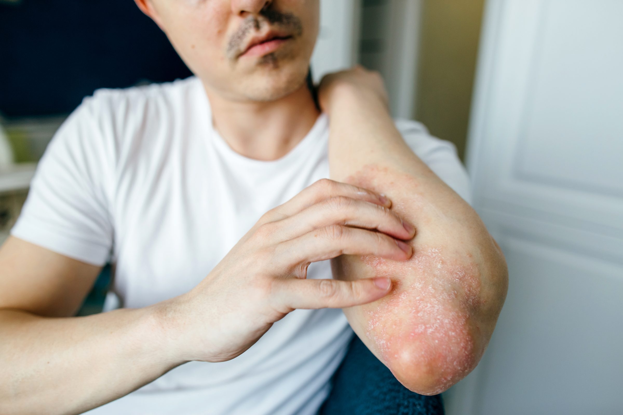 Man scratches the flaky skin on his hands with eczema, psoriasis and other skin diseases such as fungus, plaque, rash and spots. Autoimmune genetic disease.