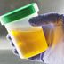 Expert Doctors: A Non-Invasive Urine Test Just â€œChanged the Gameâ€  for Prostate Screening