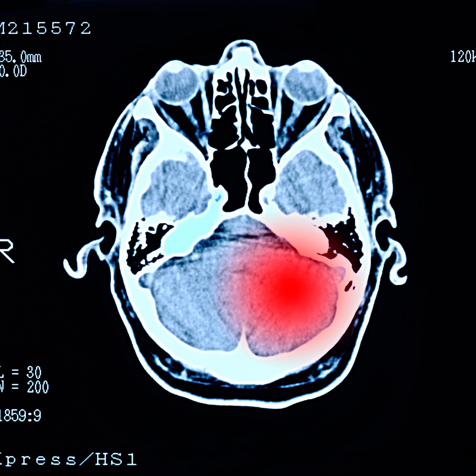 “Here’s How I Knew I Had a Brain Tumor”: One Survivor’s Story After a Common Complaint Became Too Much