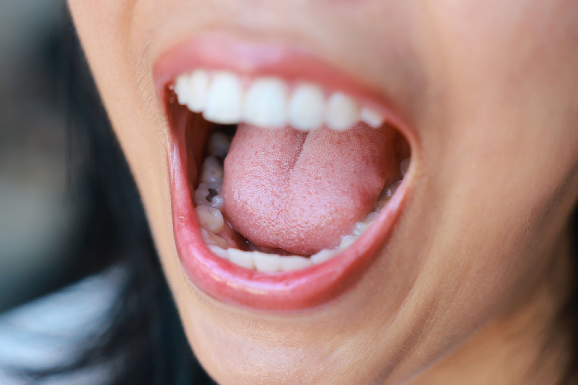 Close Up Of Tooth Decay Young Woman